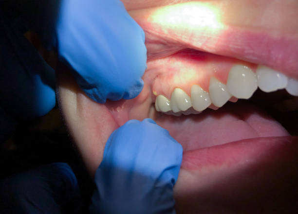 Best Dental Abscess Treatment in Potomac Heights, MD